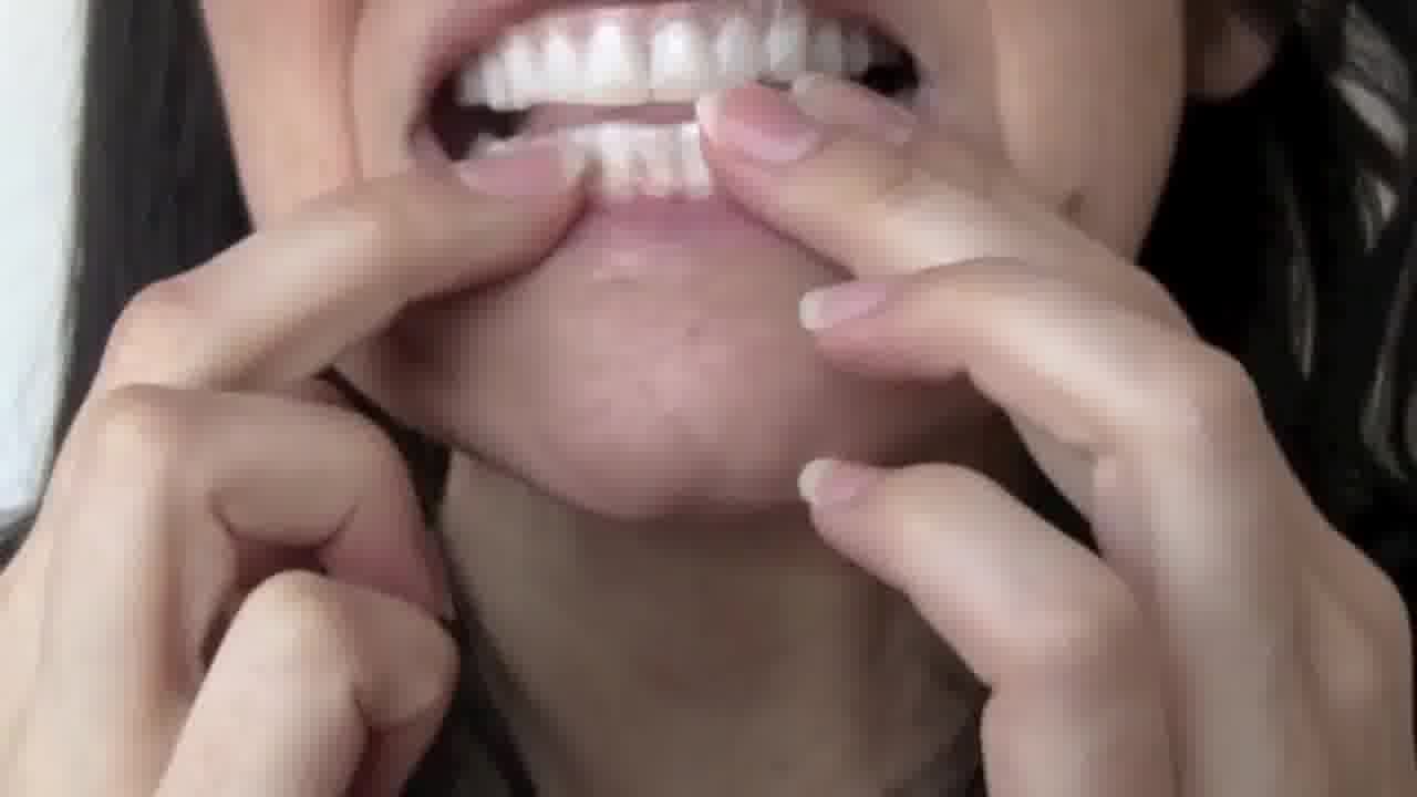  professional teeth whitening